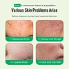 Anti Acne Pads